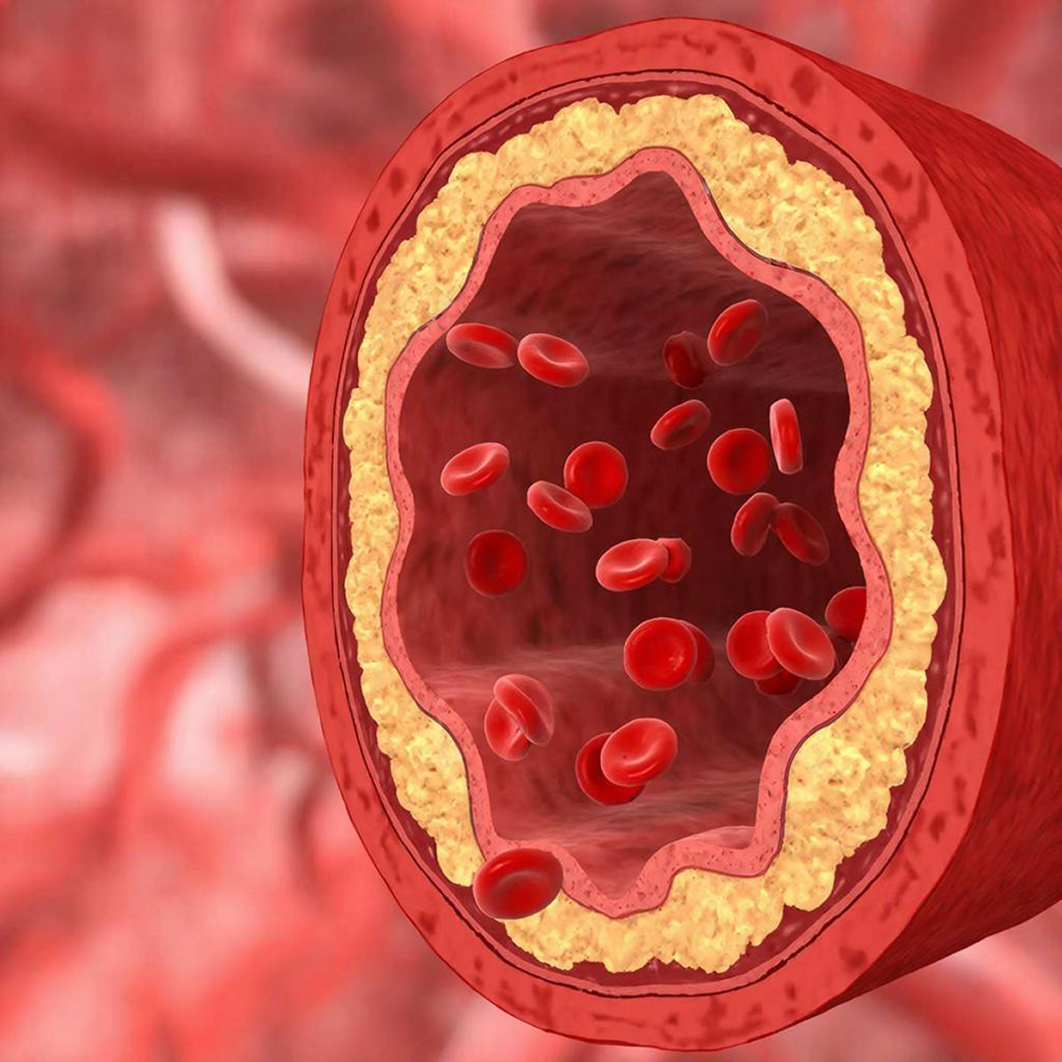 Атеросклероз - это хроническое поражение сосудов, при котором в стенке накапливаются липиды, воспалительные клетки и соединительная ткань. Со временем формируются атеросклеротические бляшки, сужающие просвет артерий и нарушающие кровоток. У людей с сахарным диабетом этот процесс развивается быстрее и протекает тяжелее.