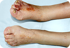 Нарушение кровоснабжения нижних конечностей (диабетическая макроангиопатия, облитерирующий атеросклероз)