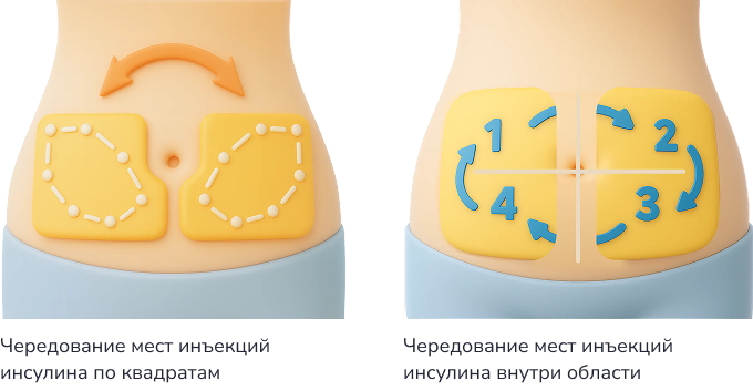 Техника инъекций инсулина